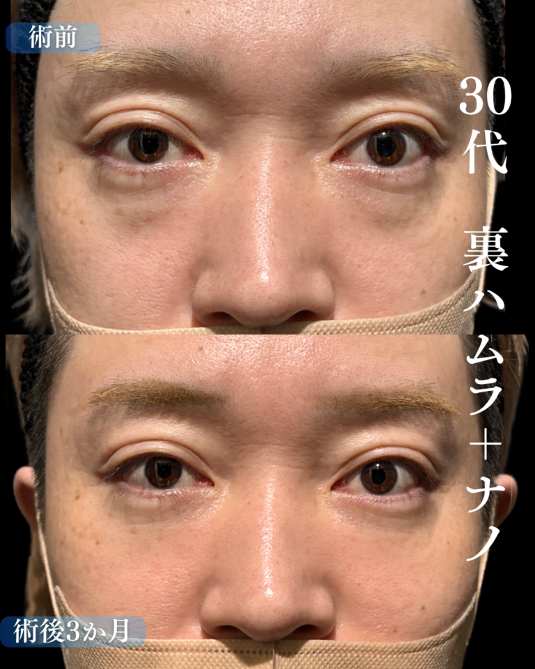 30代男性　裏ハムラ法+脂肪注入